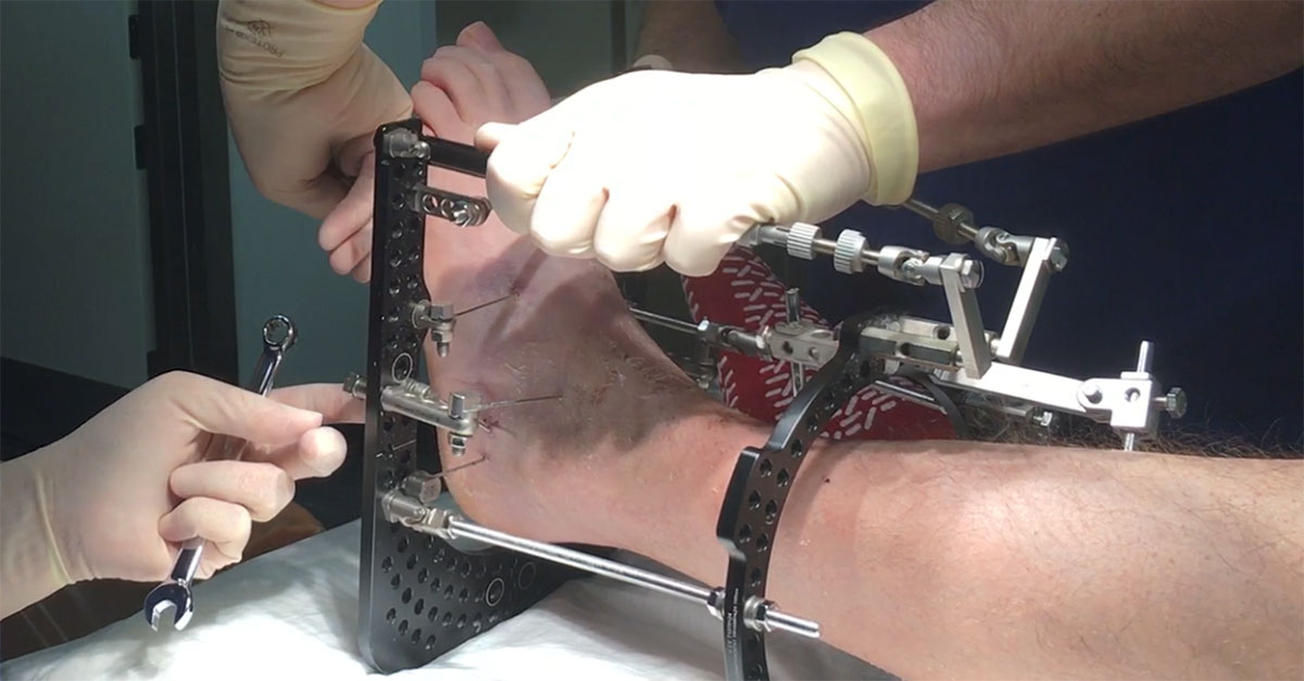 Removal of Ilizarov Frame from Ankle