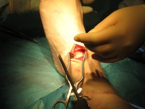 Ankle surgery - cleaning out the joint