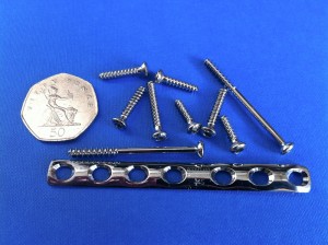 Pins and screws removed from my ankle