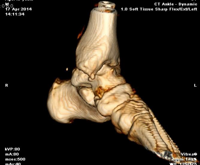 3D Scan of my Ankle