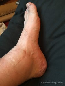 Swollen ankle almost 4 months after the frame was removed